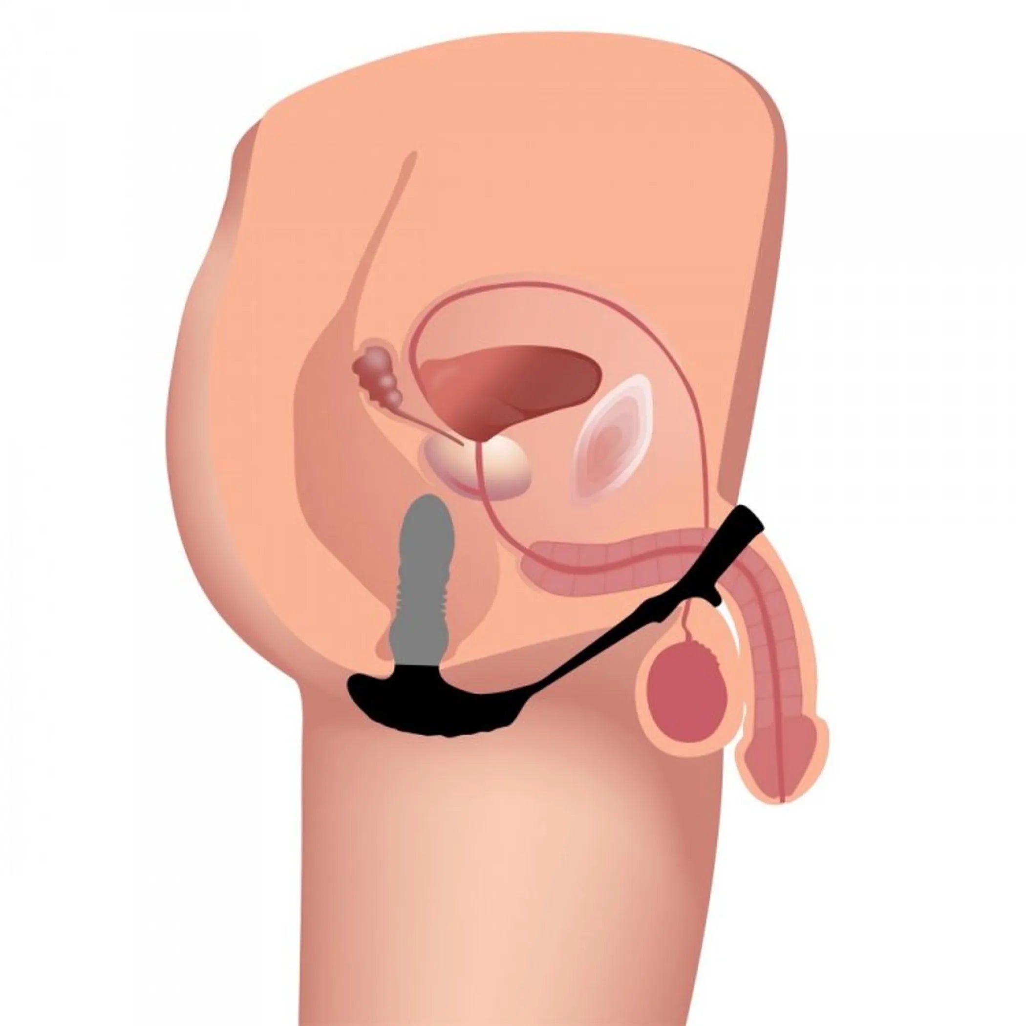 10X Thrusting Plug with Ring
